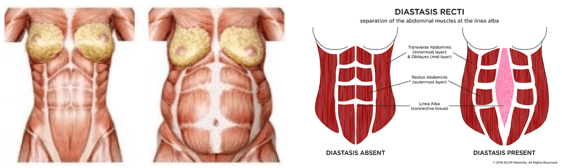 What is Abdominal Separation?